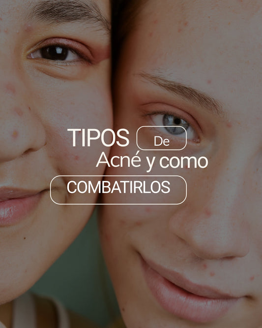 ¿Qué tipo de acné tienes y cómo combatirlo?