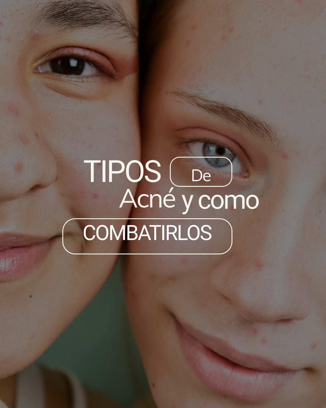 ¿Qué tipo de acné tienes y cómo combatirlo?