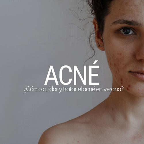 ¿Cómo cuidar y tratar el acné en verano? Consejos esenciales para tu piel